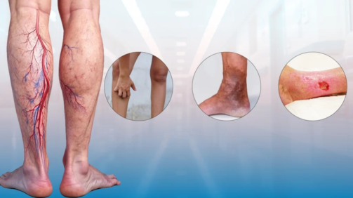 Varicose-Veins